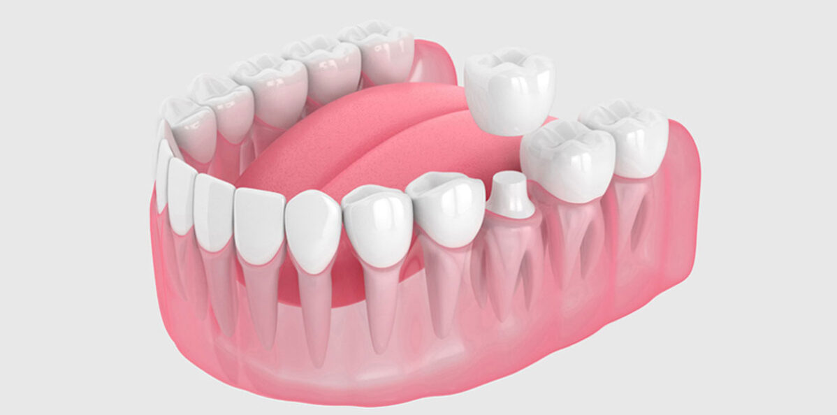 Exploring Different Types of Dental Crowns: Benefits And Aftercare Tips