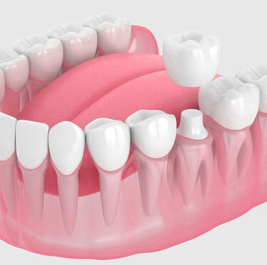 Exploring Different Types Of Dental Crowns: Benefits And Aftercare Tips