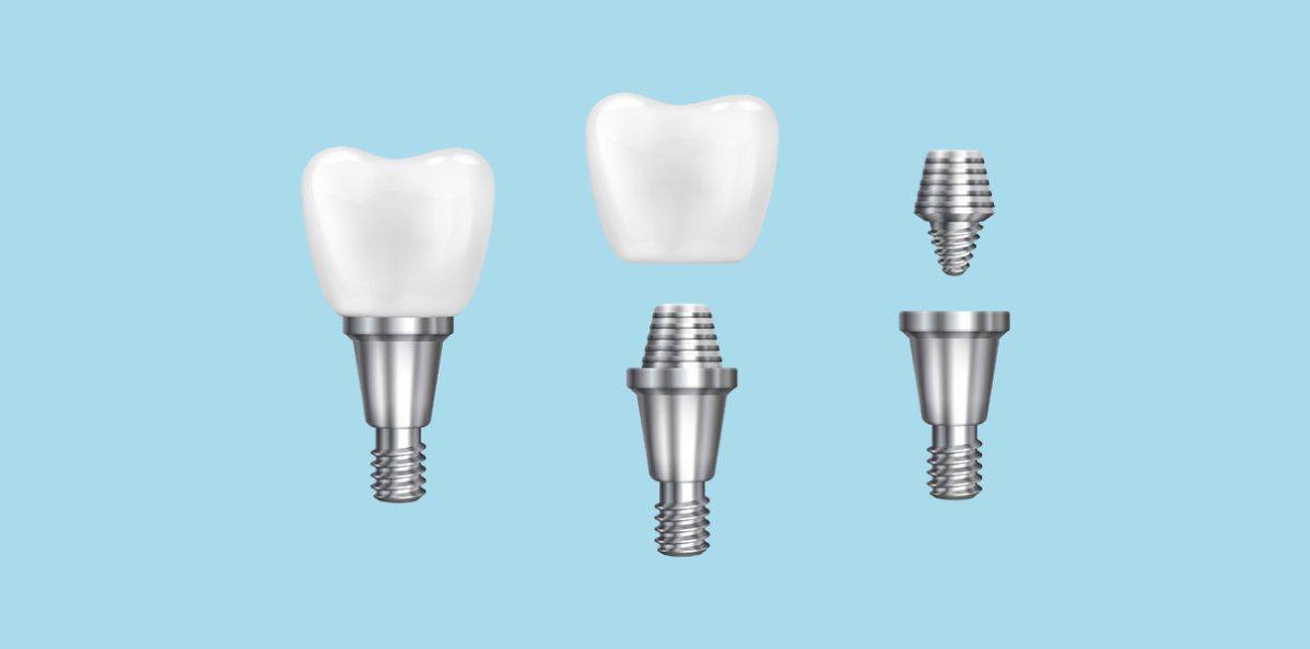Dental Implants: How Long Will They Really Last and How to Make Them Last Longer
