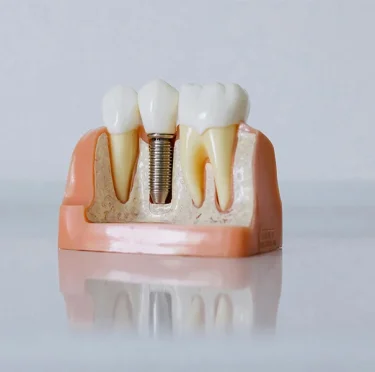 What Happens to Your Jawbone After Tooth Loss? How Dental Implants Help